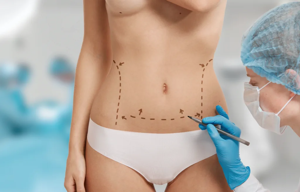 Disegno preoperatorio tracciato sull'addome di una paziente